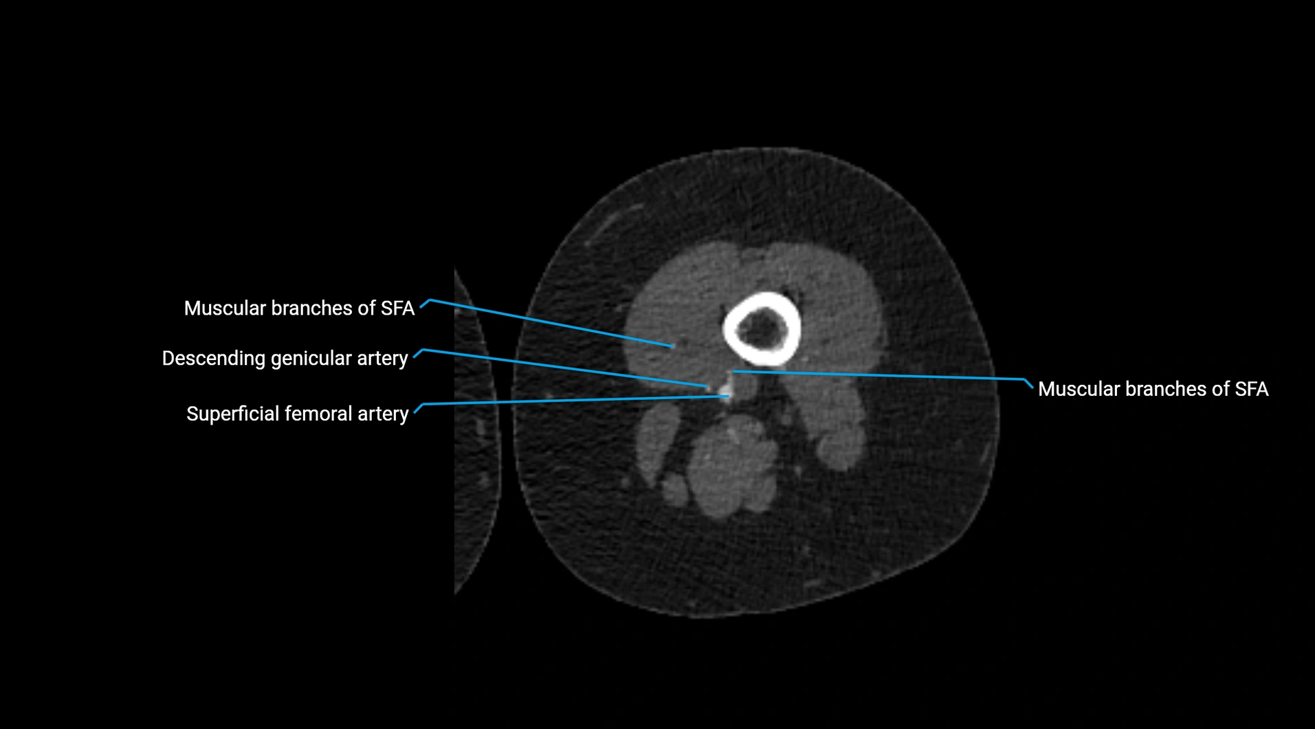 CTA lower limb cross sectional anatomy labelled image _147.webp